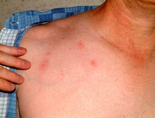 симптоми на паразити под кожата