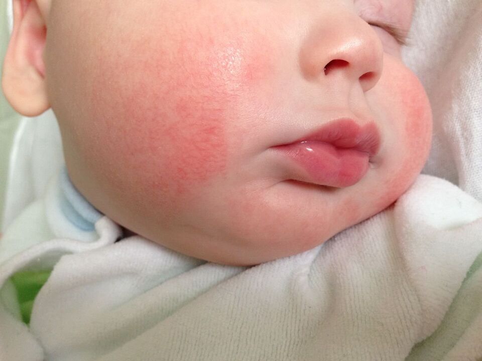 Признак за глисти при дете е алергичната уртикария